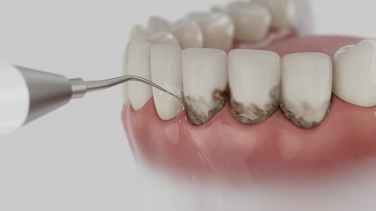 Trusted Wisdom Tooth Removal service in Tropical Park, FL - Dentist Open Now